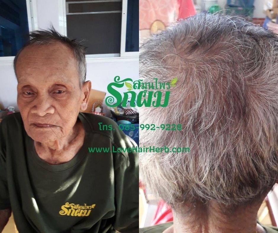 แชมพูสมุนไพรรักผม 250ml x 12 ขวด ยาสระผมแก้รังแคเชื้อรา แก้ผมร่วง แก้ปัญหาผมมัน ผมคัน ชะลอผมหงอก ช่วยให้ผมเกิดใหม่ ไม่ต้องใช้ครีมนวดผม อุดมด้วยสมุนไพรธรรมชาติถึง 9 ชนิด ใช้ได้ทุกวัย สระได้ทุกวัน ปราศจากสารเคมีที่เป็นอันตราย