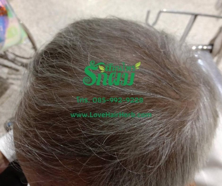 แชมพูสมุนไพรรักผม 250ml x 3 ขวด ยาสระผมแก้รังแคเชื้อรา แก้ผมร่วง แก้ปัญหาผมมัน ผมคัน ชะลอผมหงอก ช่วยให้ผมเกิดใหม่ ไม่ต้องใช้ครีมนวดผม อุดมด้วยสมุนไพรธรรมชาติถึง 9 ชนิด ใช้ได้ทุกวัย สระได้ทุกวัน ปราศจากสารเคมีที่เป็นอันตราย