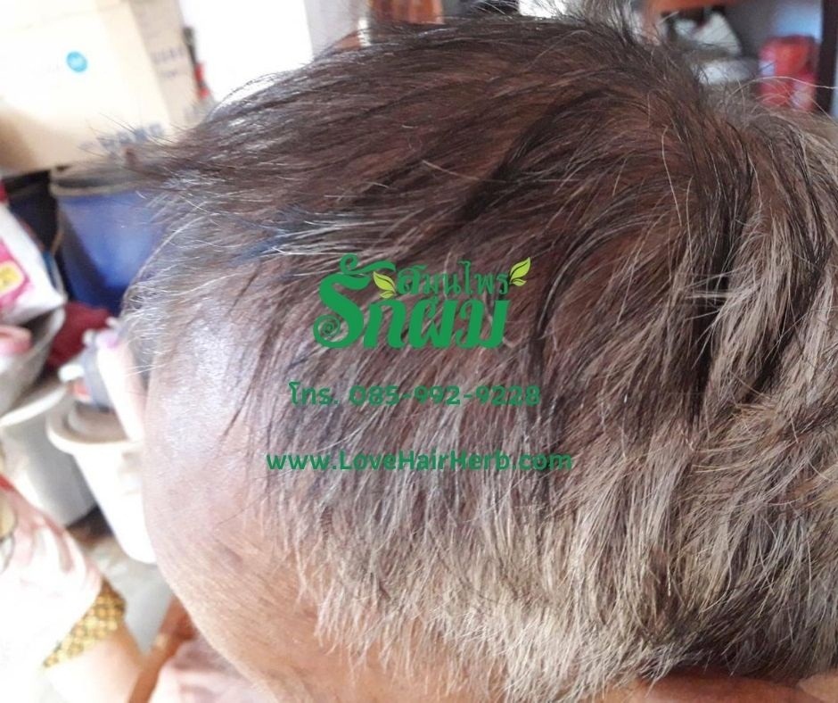 แชมพูสมุนไพรรักผม 250ml x 12 ขวด ยาสระผมแก้รังแคเชื้อรา แก้ผมร่วง แก้ปัญหาผมมัน ผมคัน ชะลอผมหงอก ช่วยให้ผมเกิดใหม่ ไม่ต้องใช้ครีมนวดผม อุดมด้วยสมุนไพรธรรมชาติถึง 9 ชนิด ใช้ได้ทุกวัย สระได้ทุกวัน ปราศจากสารเคมีที่เป็นอันตราย