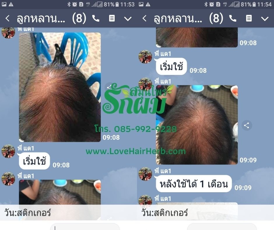 แชมพูสมุนไพรรักผม 250ml x 12 ขวด ยาสระผมแก้รังแคเชื้อรา แก้ผมร่วง แก้ปัญหาผมมัน ผมคัน ชะลอผมหงอก ช่วยให้ผมเกิดใหม่ ไม่ต้องใช้ครีมนวดผม อุดมด้วยสมุนไพรธรรมชาติถึง 9 ชนิด ใช้ได้ทุกวัย สระได้ทุกวัน ปราศจากสารเคมีที่เป็นอันตราย