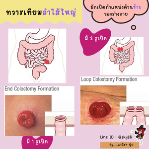 ญาติของเรา มีทวารเทียมส่วนไหน