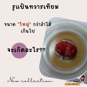 การใช้แป้นติดทวารเทียมใหญ่กว่าลำไส้ก็เครียดไ้ด้